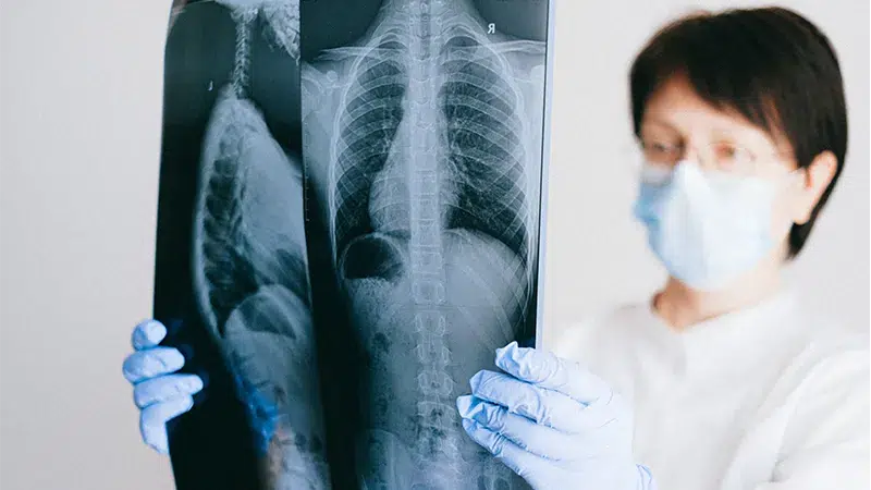 Cannabis Oil Benefits for Lungs